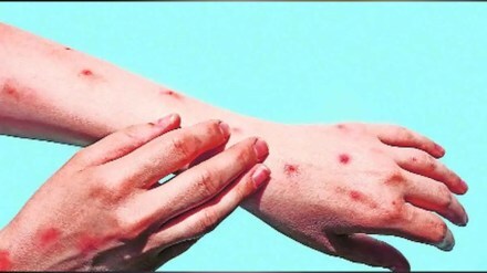 pune doctors spread rumours of monkeypox