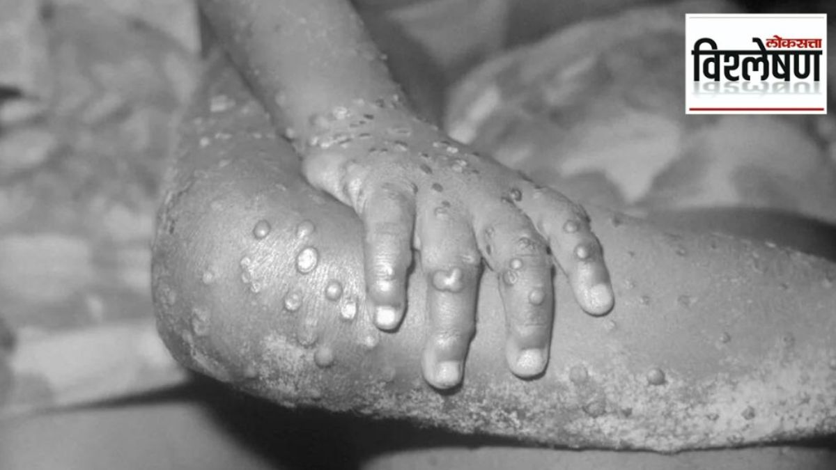 monkeypox india