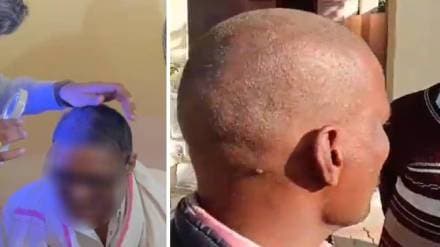 Harshvardhan Sapkal statement regarding the hair loss case in Buldhana
