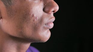 Testosterone and acne