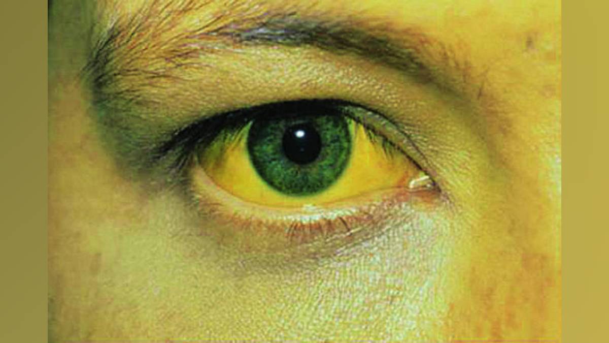 jaundice has spread in rajur in akole taluka with 97 jaundice like patients found in a week