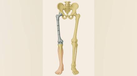 tanzanian patient walked again after Pune doctors successfully transplanted his entire thigh bone