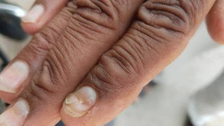 Shegaon taluka the fingernails of the villagers are falling off In Bondgaon