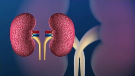 kidney stone latest news