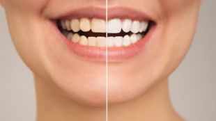 teeth whitening tips in marathi