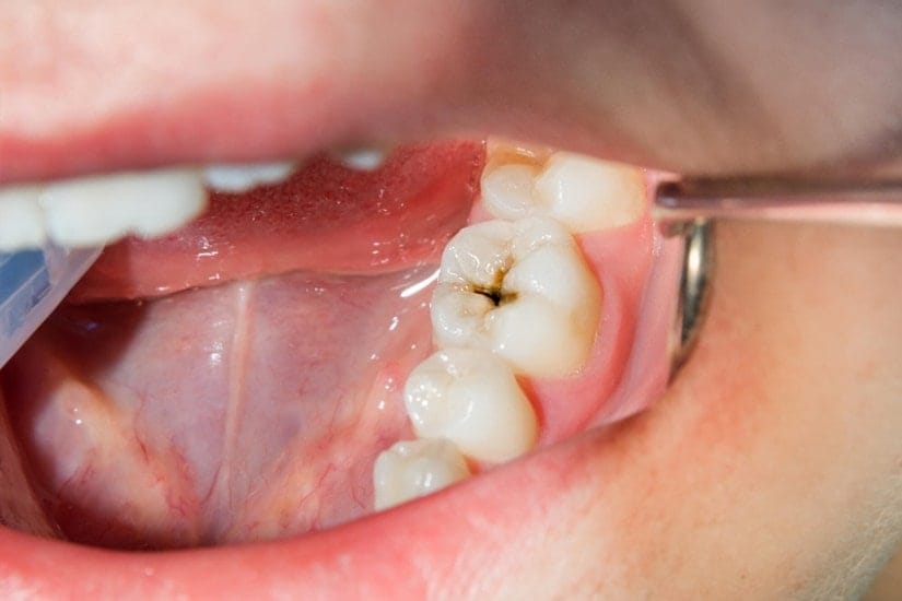 how to remove black stains from teeth naturally