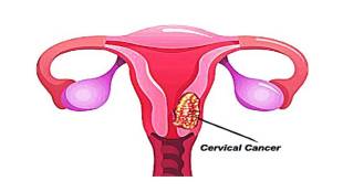 AIIMS develops cervical cancer test to help beat cancer