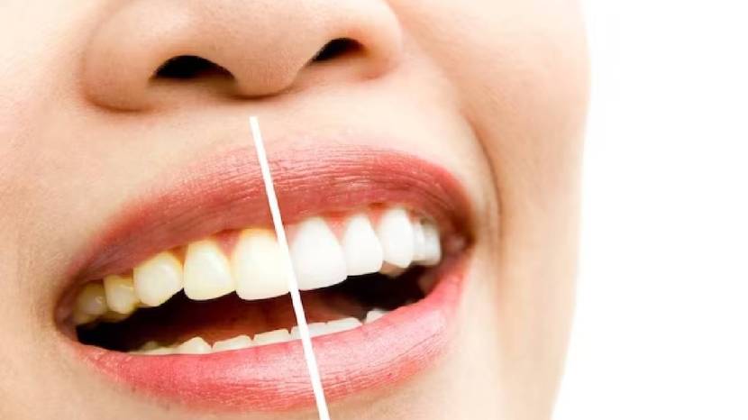 How to Get Rid of Yellow Teeth