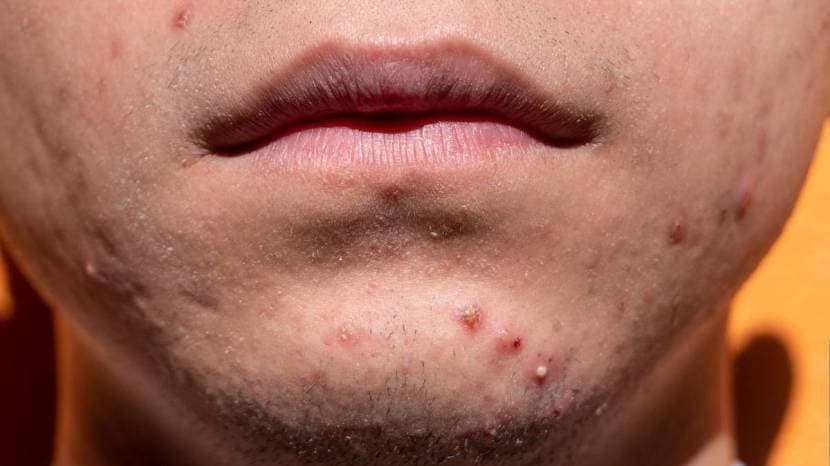 Best Skincare Routine for Pimples