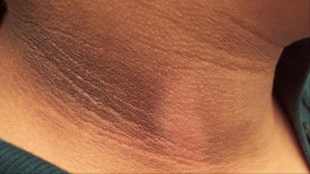 Say Goodbye to Dark Neck with These 9 Effective Home Remedies