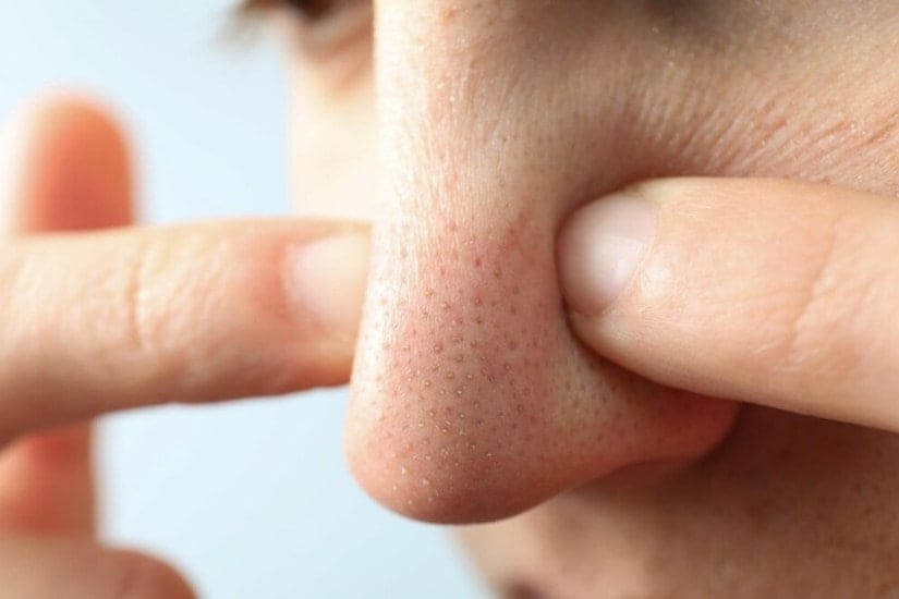 clogging of pores