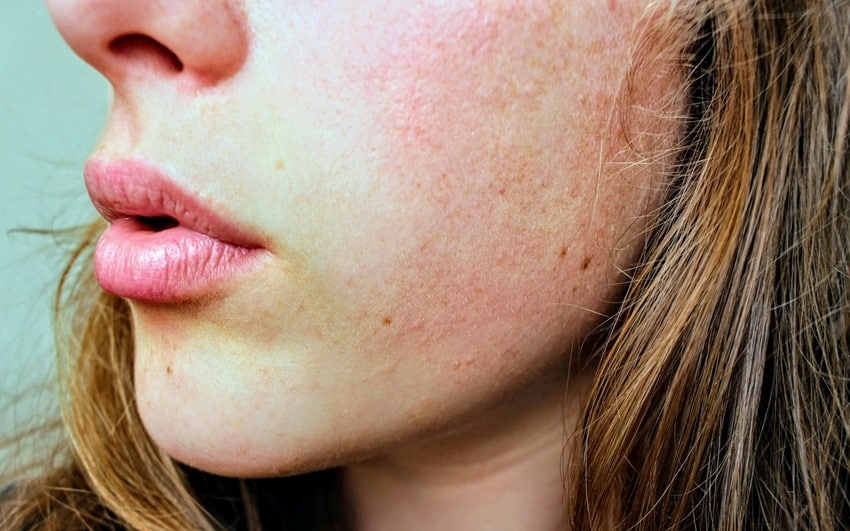 rice water skin irritation