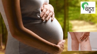 The problem of varicose veins that troubles pregnant women take these precautions