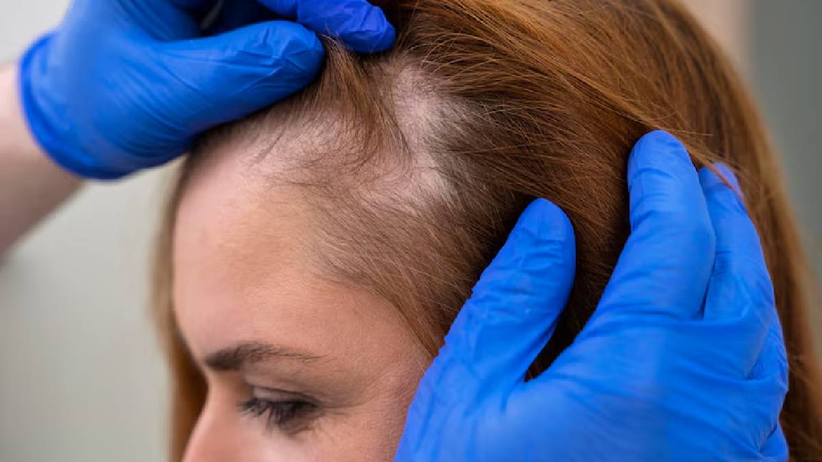 Did You Know? These Everyday Foods Might Be Contributing To Hair Loss Hair Loss tips