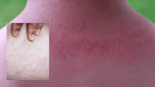 Ghamole itching on body in summers and rainy season add lemon camphor to bath water