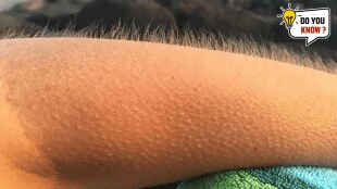 Why Do We Get Goosebumps Do You Know that