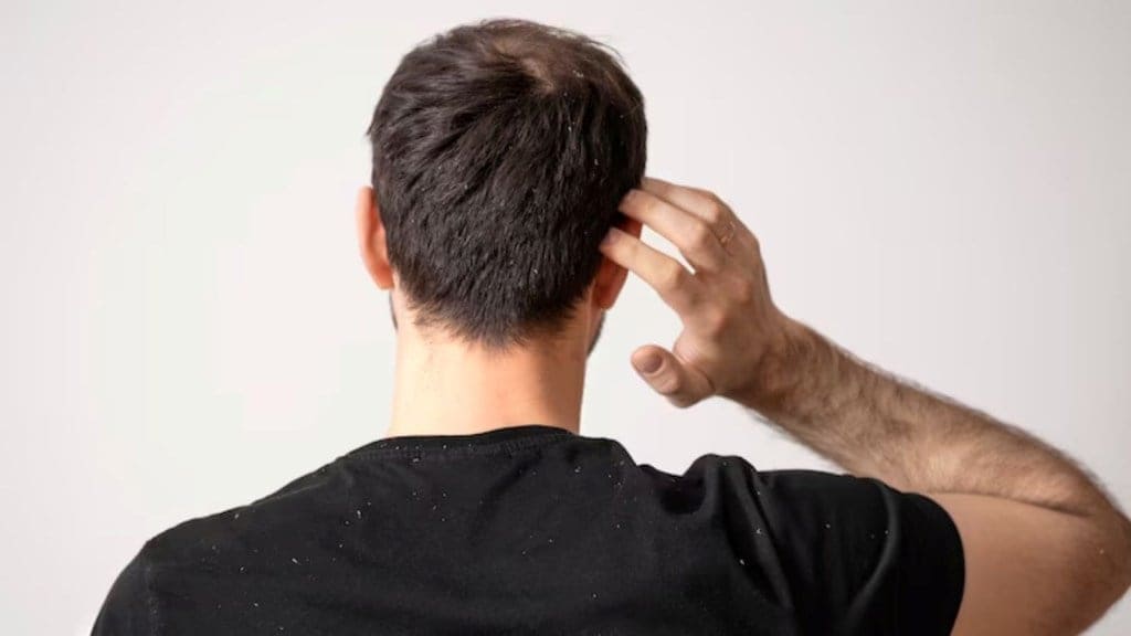 Scalp fungal infections, hair care tips