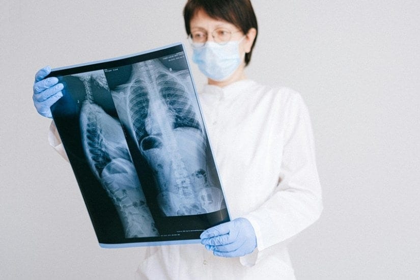 Amrita Hospital Doctors Straighten 50-Degree Spine Curve in Remarkable Surgery