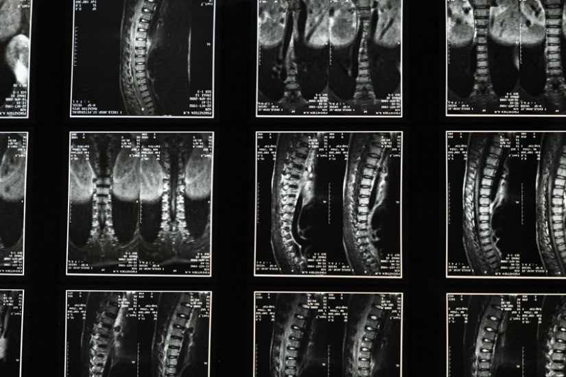 Early Detection is Key 1 in 10 Children at Risk of Scoliosis