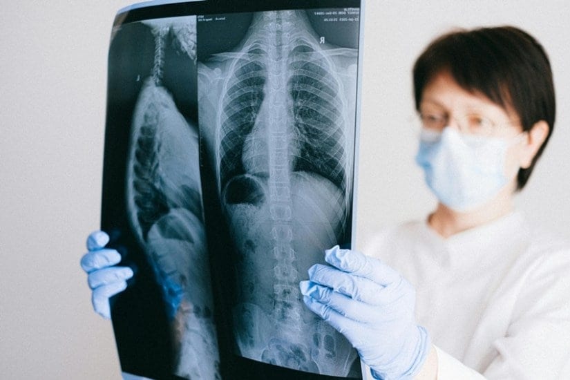 From Curve to Confidence 13-Year-Old Noida Girl Beats Scoliosis in Just 5 Days
