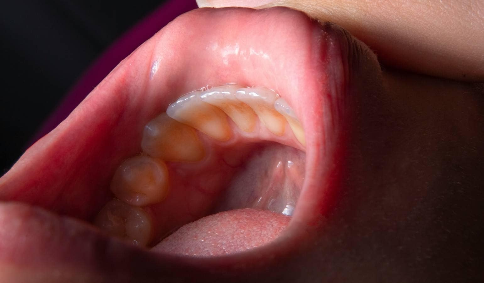How to Remove Yellow Teeth Stains at Home
