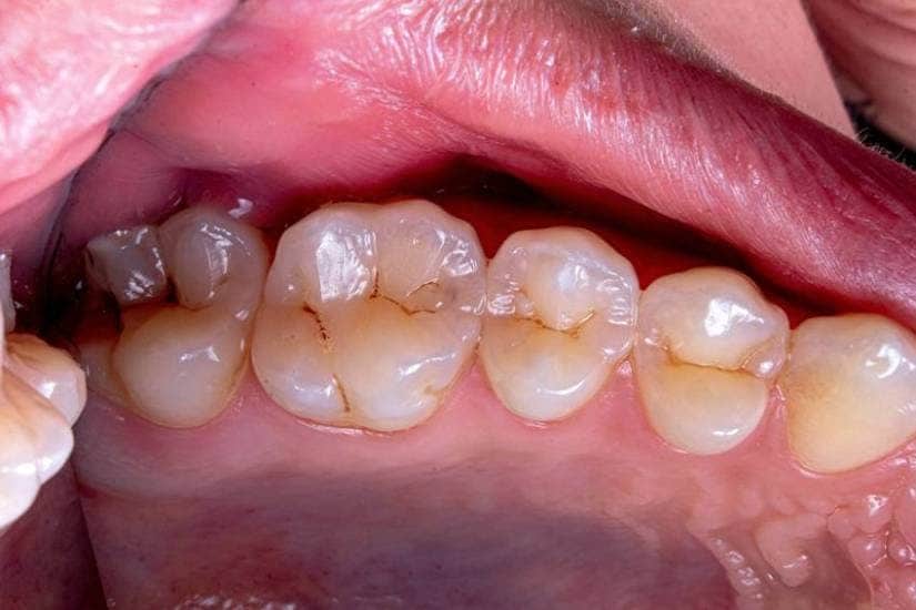 10 home remedies for yellow teeth