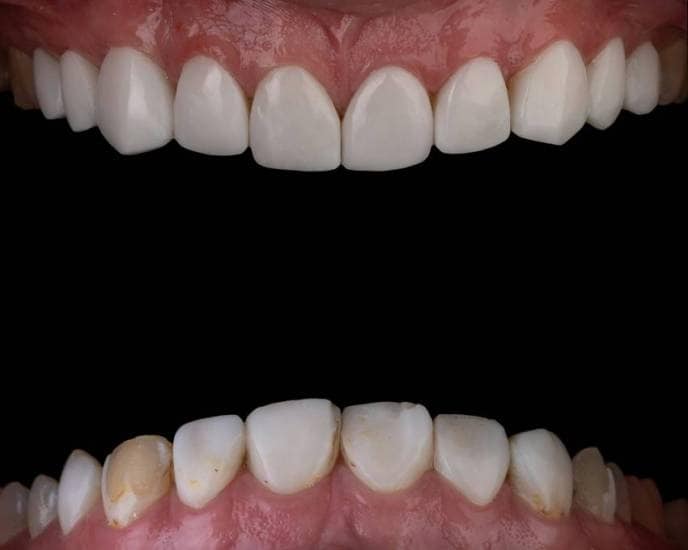 Remove yellow teeth stains