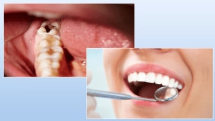 tooth cavity bad breath teeth decay Oral health home remedy prevent from cavity